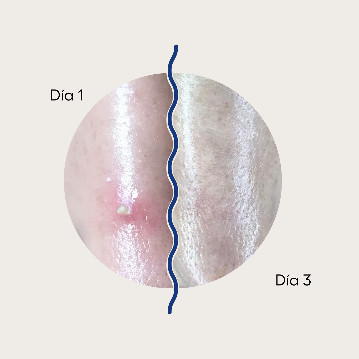 Curadots™ PM Parches para Acné