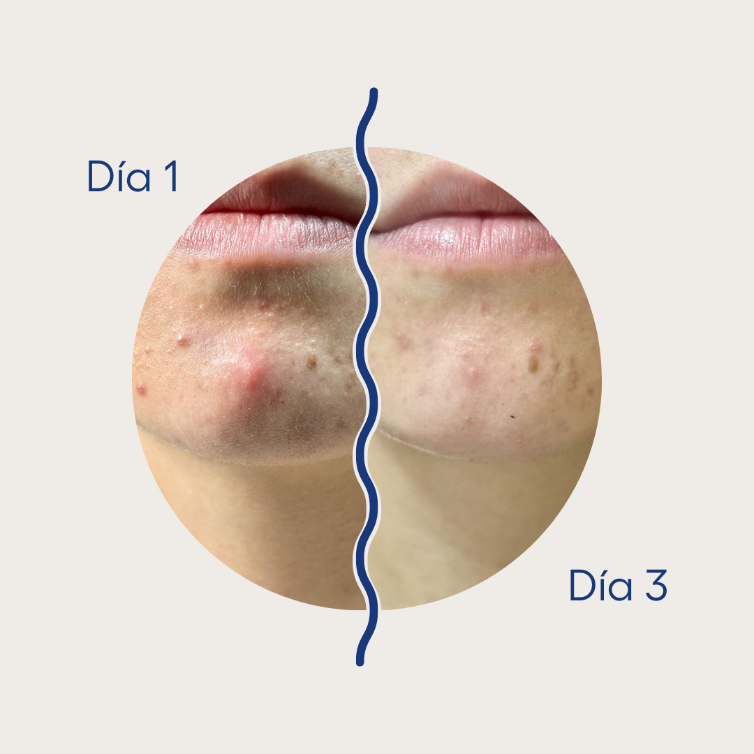 Curadots™ AM parches invisibles para Acné